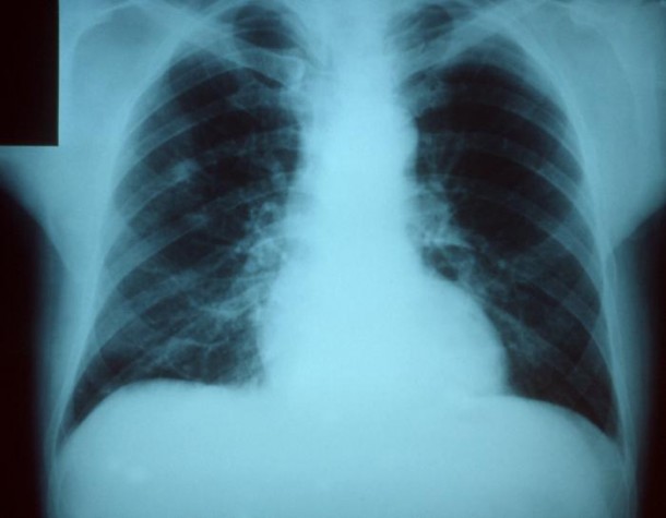 Pneumonia o pulmonya: Sanhi sintomas, gamot, lunas, remedies